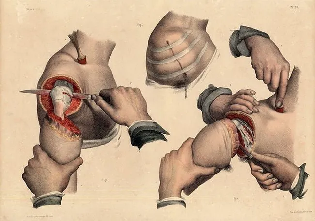Nicolas Henri Jacob: amputación del hombro