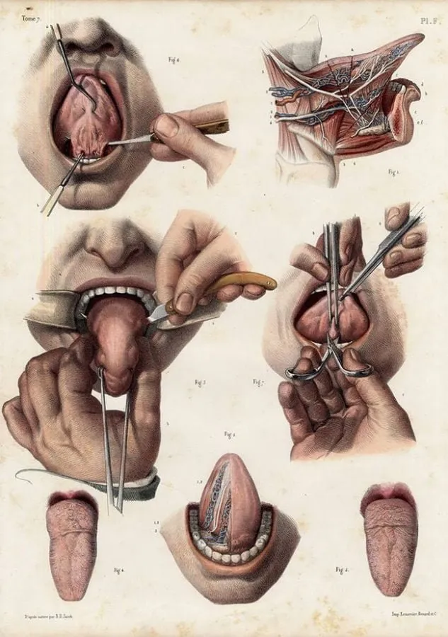 Nicolas Henri Jacob: cirugía de la lengua