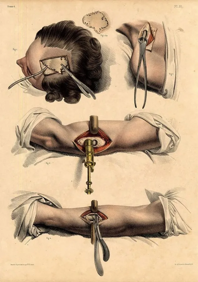 Nicolas Henri Jacob: trepanación craneal