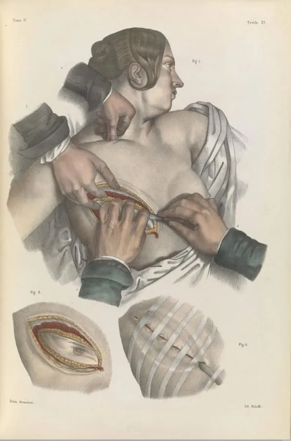 Nicolas Henri Jacob: cirugía de la clavícula