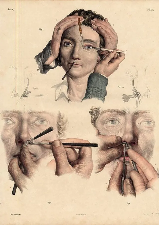 Nicolas Henri Jacob: cirugía del conducto lagrimal