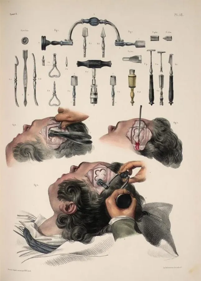 Nicolas Henri Jacob: instrumental de trepanación craneal
