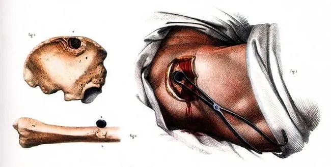 Nicolas Henri Jacob: extracción ósea en el brazo