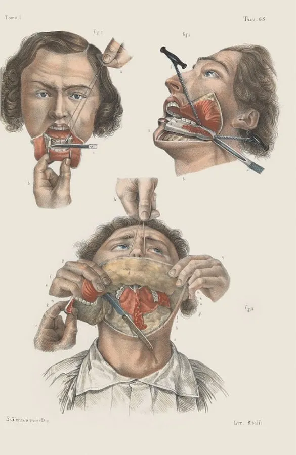 Nicolas Henri Jacob: disección de la mandíbula