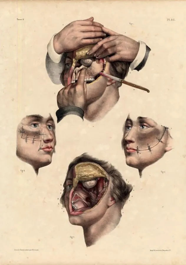 Nicolas Henri Jacob: cirugía maxilofacial