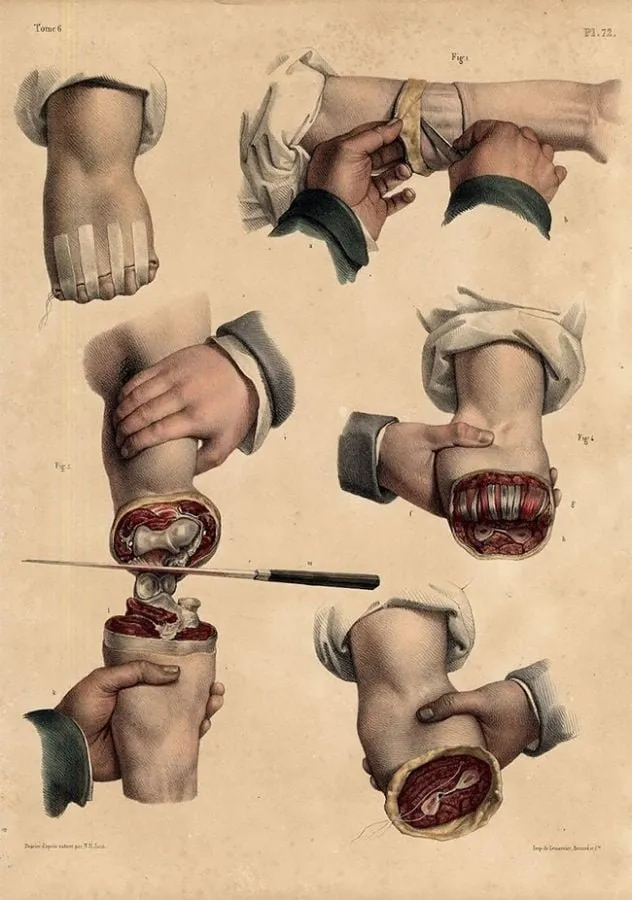 Nicolas Henri Jacob: cirugía de mano y muñeca