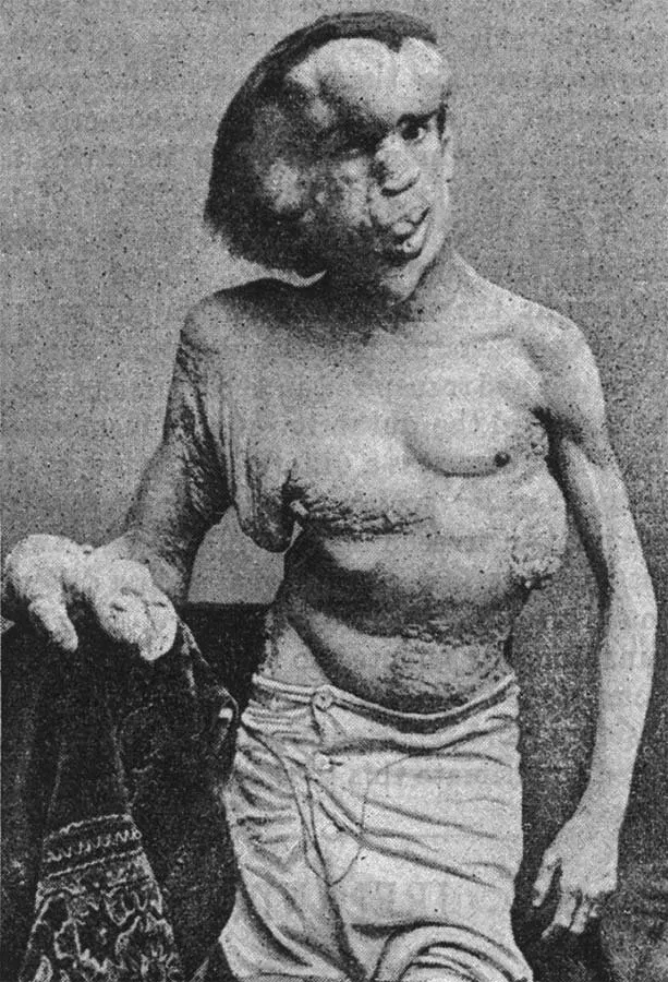 Joseph merrick hombre elefante