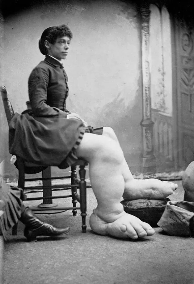Mujer con la pierna y el pie hinchados, posiblemente Fanny Mills