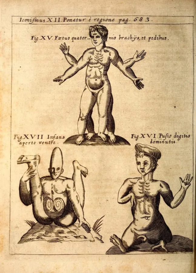 Feto con cuatro extremidades y niño con el vientre abierto, grabado de «Physica Curiosa» (1662)