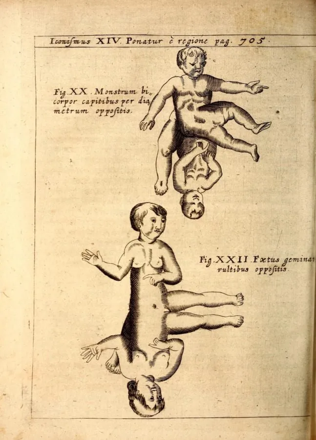Gemelos siameses de cabezas opuestas, grabado de «Physica Curiosa» (1662)