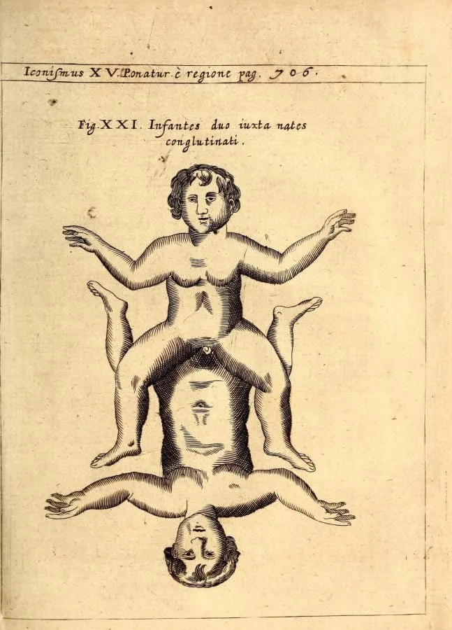 Gemelos unidos por las nalgas, grabado de «Physica Curiosa» (1662)